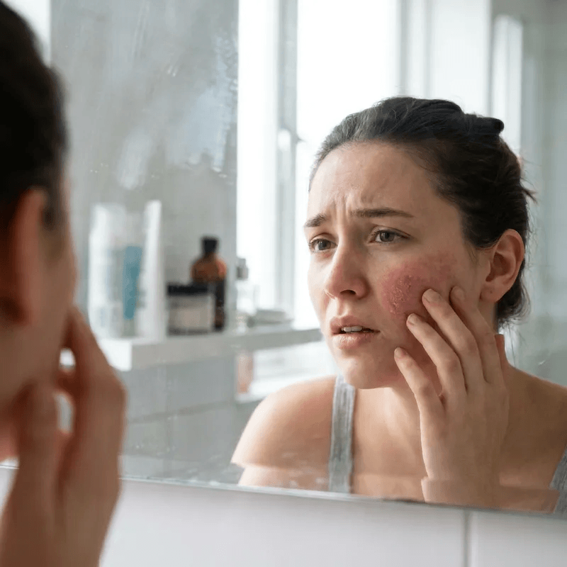 Woman with red, irritated skin showing signs of sensitivity