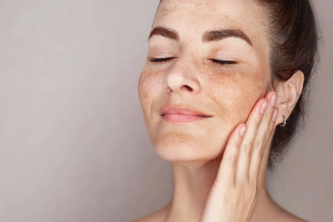 Actual solution to hyperpigmentation of which majority of people are unaware.