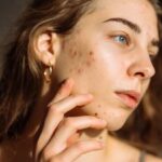  Jawline acne isn't random; it's often hormonal. Learn the real cause behind chin and jaw breakouts and the routine that actually works.