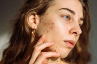  Jawline acne isn't random; it's often hormonal. Learn the real cause behind chin and jaw breakouts and the routine that actually works.