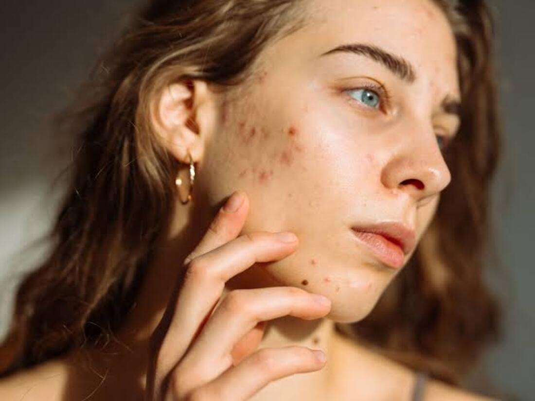  Jawline acne isn't random; it's often hormonal. Learn the real cause behind chin and jaw breakouts and the routine that actually works.