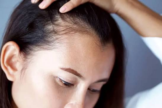 girl with hair loss problem.